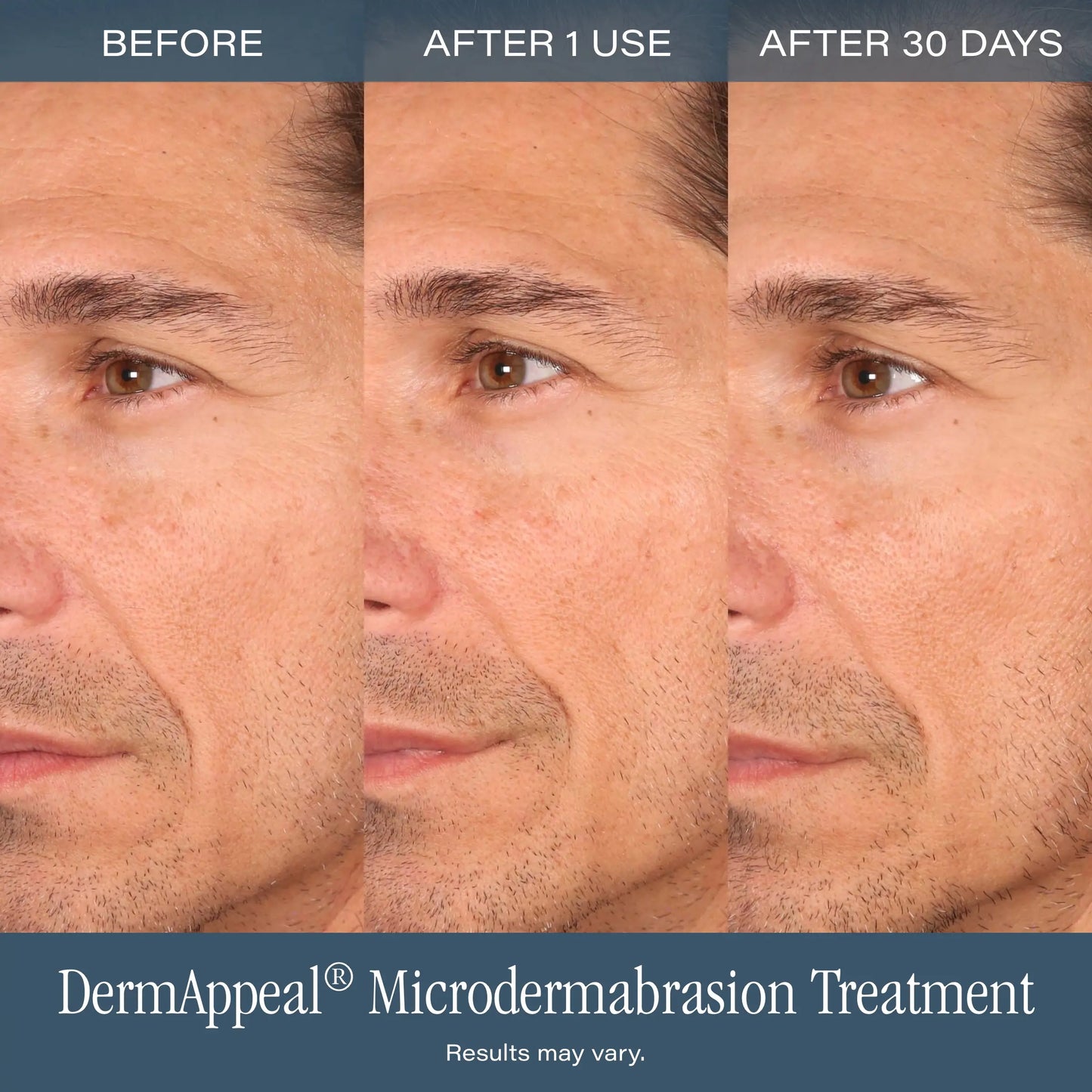 SKINN Cosmetics Dermappeal Microdermabrasion Beautytreatment W/ V5 Crystal Technology Facial Exfoliate Tube - Powerful Microdermabrasion Skincare Treatment for All Skin Types Brightening Exfoliating Moisturizing Chemical Exfoliant