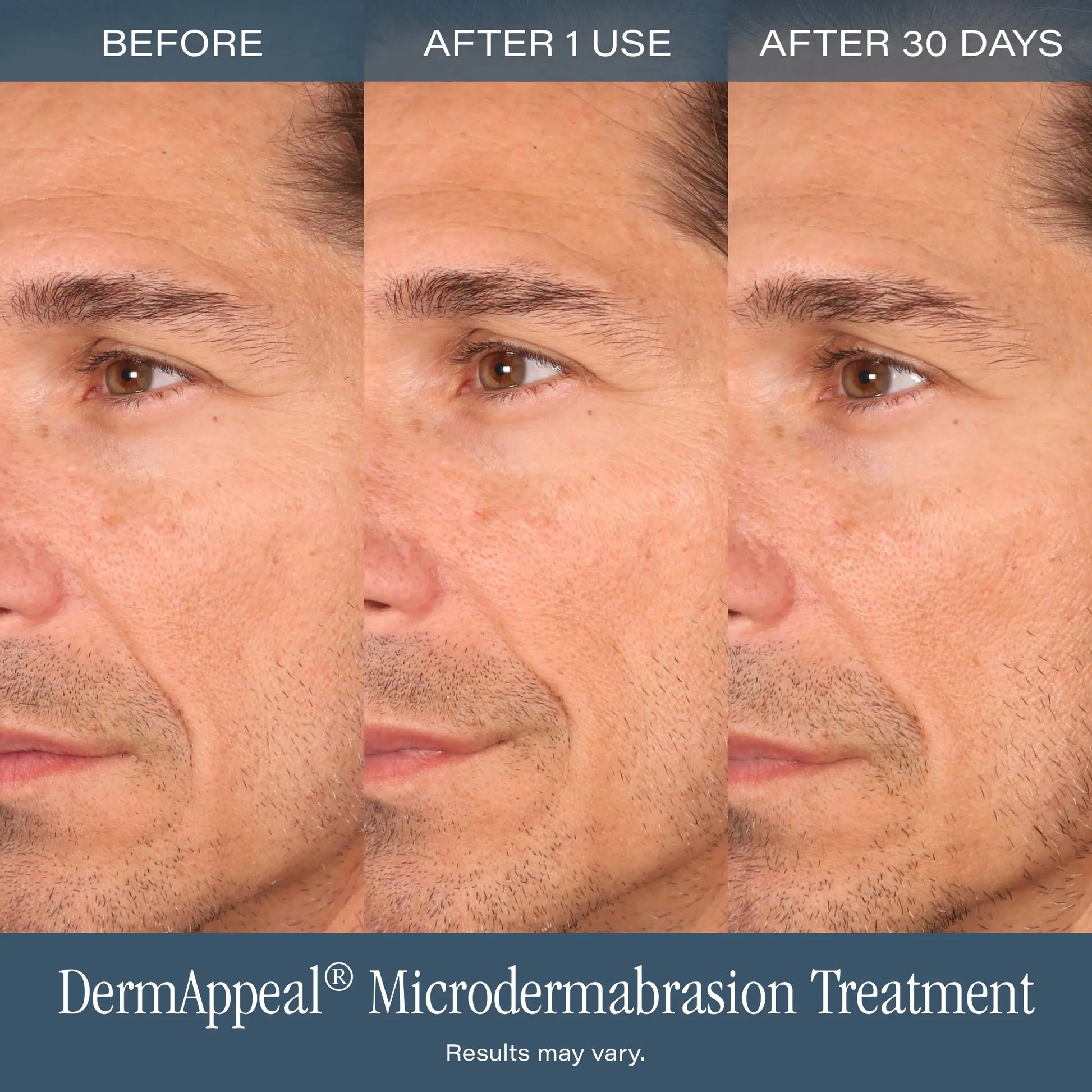 SKINN Cosmetics Dermappeal Microdermabrasion Beautytreatment W/ V5 Crystal Technology Facial Exfoliate Tube - Powerful Microdermabrasion Skincare Treatment for All Skin Types Brightening Exfoliating Moisturizing Chemical Exfoliant