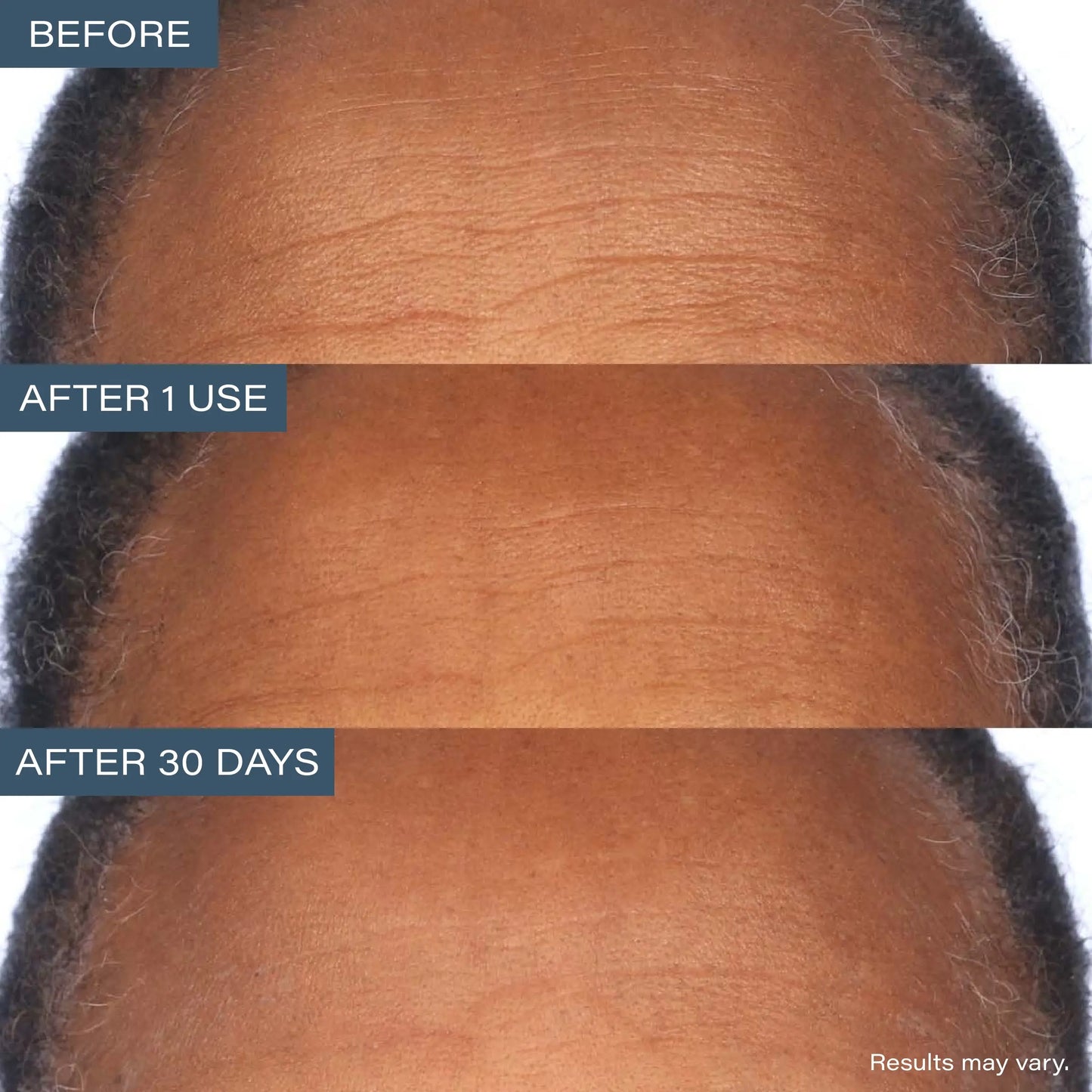SKINN Cosmetics Dermappeal Microdermabrasion Beautytreatment W/ V5 Crystal Technology Facial Exfoliate Tube - Powerful Microdermabrasion Skincare Treatment for All Skin Types Brightening Exfoliating Moisturizing Chemical Exfoliant