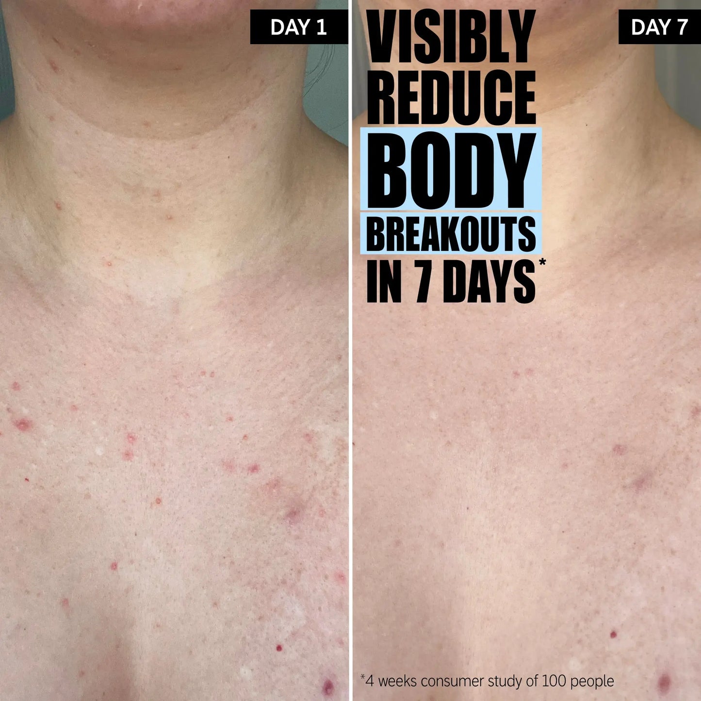 The INKEY List - Glycolic Acid Exfoliating Body Stick for Smooth Skin, Ingrown Hairs, Body Breakouts Discoloration and to Exfoliate