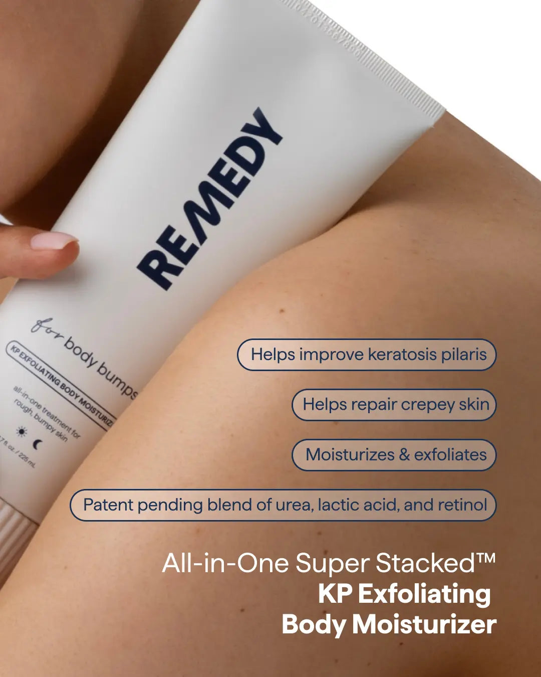 REMEDY KP Exfoliating Body Moisturizer - New Size: 7.7 Fl Oz.